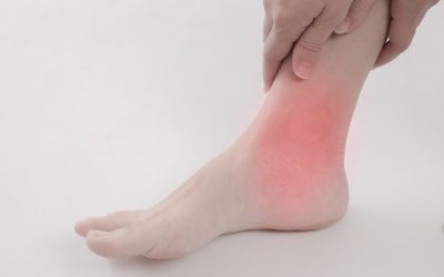 Cankles: What Are They & How To Avoid Them